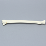 Radius with Fracture for Volar Plate, Foam Cortical