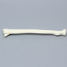 Radius with Fracture for Volar Plate, Foam Cortical