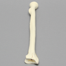 Radius with Three-Part Intra-Articular Fracture, Foam Cortical, Right