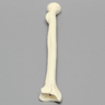 Radius with Three-Part Intra-Articular Fracture, Foam Cortical, Right
