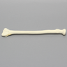 Radius with Three-Part Intra-Articular Fracture, Foam Cortical, Right