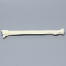 Radius with Four-Part Fracture, Foam Cortical