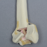 Radius with Four-Part Fracture, Foam Cortical
