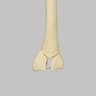 Radius with Three-Part Intra-Articular Fracture and Removed Tubercle, Foam Cortical