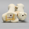 Ulna and Radius with Volar Fracture, Foam Cortical