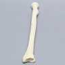 Radius with Three-Part Intra-articular Fracture, Foam Cortical