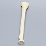 Radius with Three-Part Intra-articular Fracture, Foam Cortical