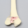 Radius with Three-Part Intra-articular Fracture, Foam Cortical
