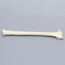 Radius with Distal Five-Part Intra-Articular Fracture, Foam Cortical