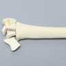 Radius with Distal Five-Part Intra-Articular Fracture, Foam Cortical