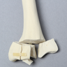 Radius with Distal Five-Part Intra-Articular Fracture, Foam Cortical