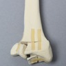 Radius with Distal Five-Part Intra-Articular Fracture, Foam Cortical