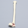 Radius with Transverse Fracture and Fragment, Foam Cortical