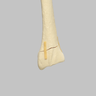 Radius with Transverse Fracture, Foam Cortical