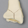 Radius with "Y" Fracture, Foam Cortical