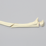 Ulna with Oblique and Transverse Fractures, Foam Cortical