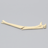 Ulna with Oblique and Transverse Fractures, Foam Cortical