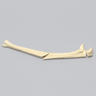 Ulna with Oblique and Transverse Fractures, Foam Cortical