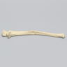 Ulna with Oblique and Transverse Fractures, Foam Cortical