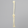 Elbow with Lateral Humeral Condyle Fracture, Foam Cortical