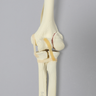 Elbow with Lateral Humeral Condyle Fracture, Foam Cortical
