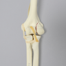 Elbow with Lateral Humeral Condyle Fracture, Foam Cortical