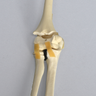 Elbow with Distal Fracture, Pediatric, Solid Foam