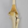 Elbow with Distal Fracture, Pediatric, Solid Foam