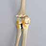 Elbow with Distal Fracture, Pediatric, Solid Foam