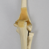 Elbow with Distal Fracture, Pediatric, Solid Foam