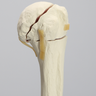 Elbow with Four-Part Fracture, Foam Cortical