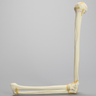 Elbow with Four-Part Fracture, Foam Cortical