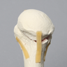 Elbow with Four-Part Fracture, Foam Cortical