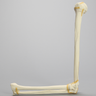 Elbow with Four-Part Fracture, Foam Cortical