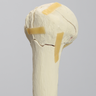 Elbow with Four-Part Fracture, Foam Cortical