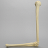 Elbow with Transverse Fracture, Foam Cortical