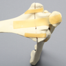 Elbow with Transverse Fracture, Foam Cortical