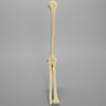 Elbow with Transverse Fracture, Foam Cortical