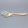 Hand and Wrist with Transverse Radial Fracture, Solid Foam