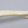 Clavicle with Transverse Fracture, Solid Foam