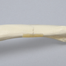 Clavicle with Transverse Fracture, Solid Foam