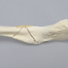 Clavicle with Butterfly Fracture, Solid Foam