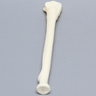 Radius with Transverse Colles' Fracture and Removed Tubercle, Foam Cortical