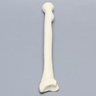 Radius with Transverse Colles' Fracture and Removed Tubercle, Foam Cortical