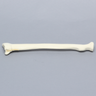 Radius with Transverse Colles' Fracture and Removed Tubercle, Foam Cortical