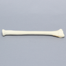 Radius with Transverse Colles' Fracture and Removed Tubercle, Foam Cortical