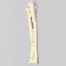 Ulna and Radius with Oblique and Transverse Fractures, Foam Cortical