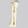 Ulna and Radius with Oblique and Transverse Fractures, Foam Cortical