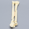 Ulna and Radius with Oblique and Transverse Fractures, Solid Foam