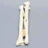Ulna and Radius with Four-Part and Oblique Fractures, Solid Foam